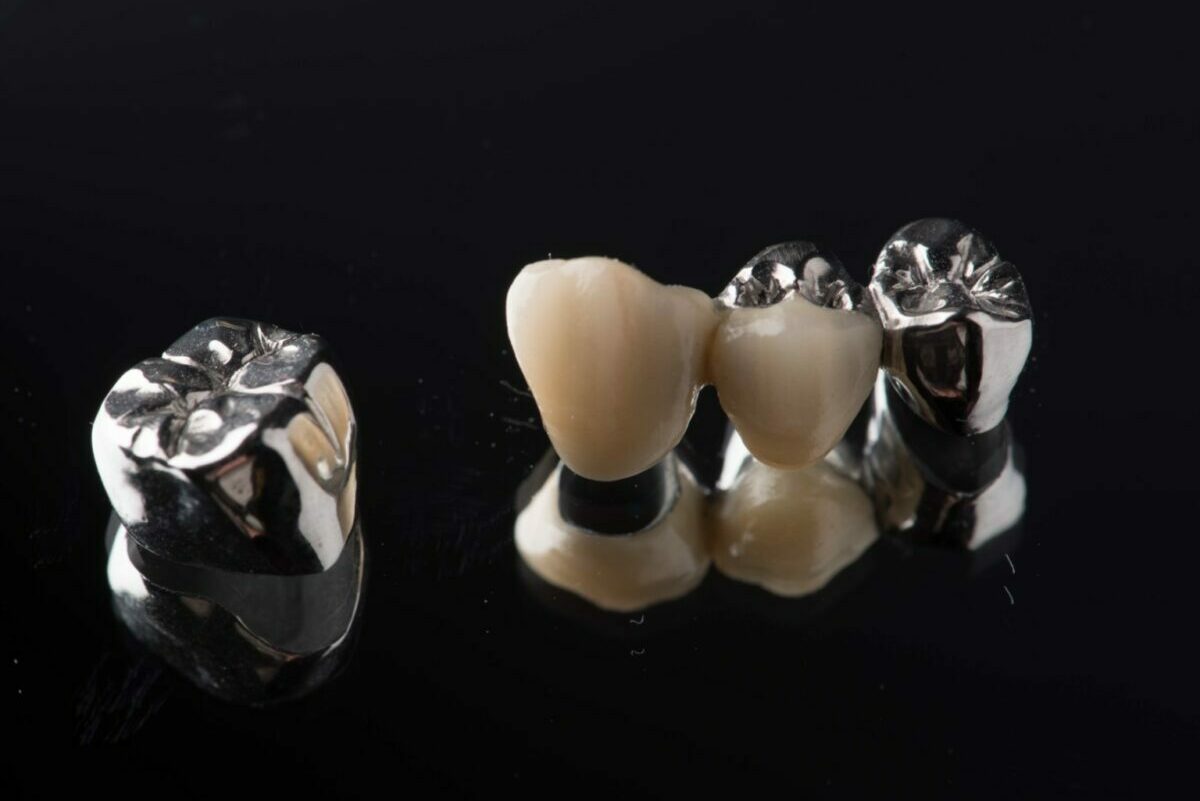 Couronne céramo-métallique - Laboratoire 3D Dental Impression
