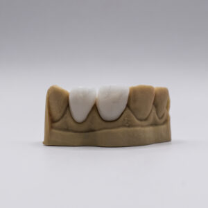 Facette E-max