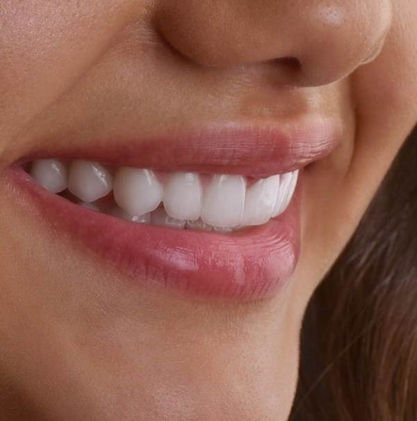 Gouttière de blanchiment Laboratoire 3D Dental Impression