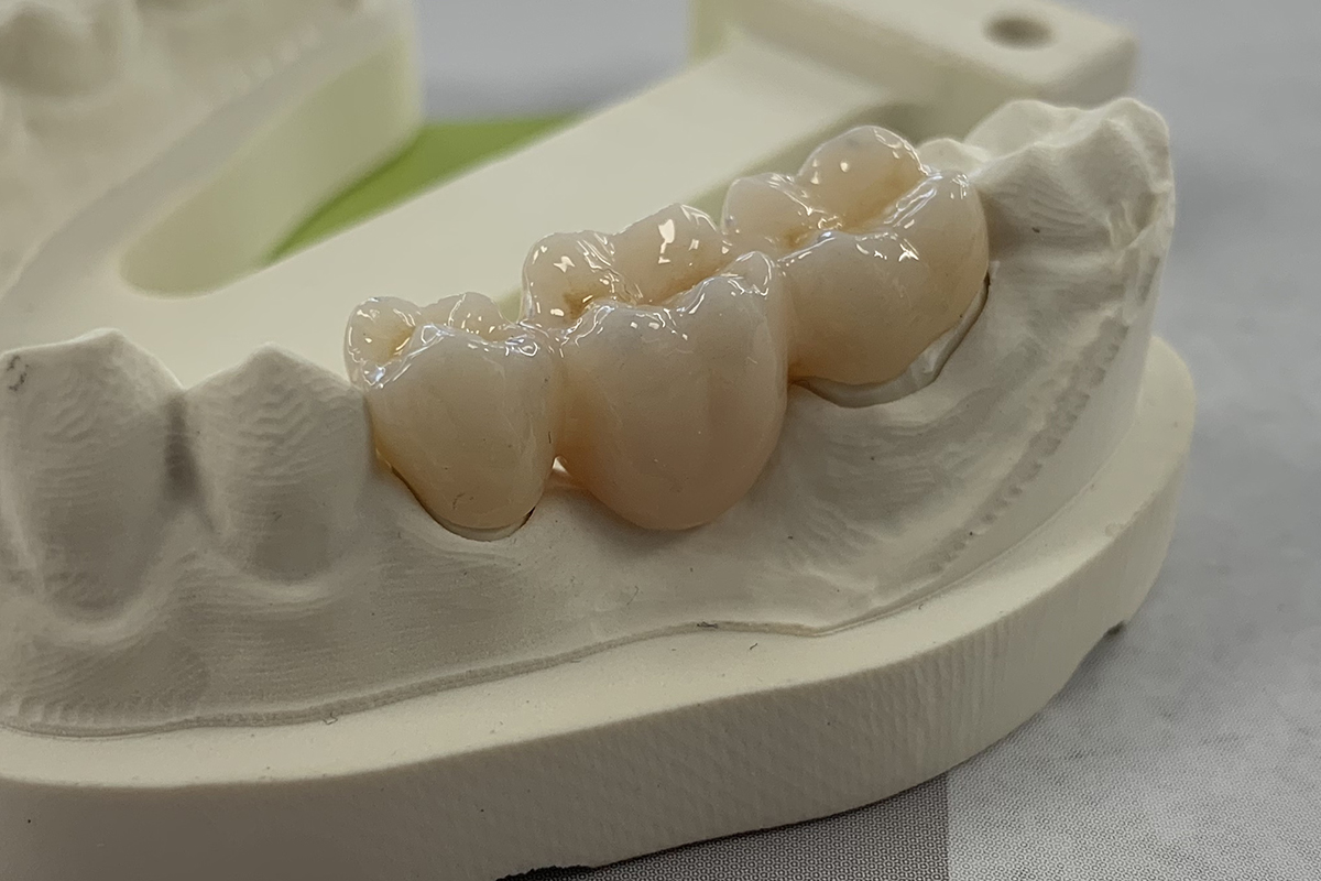 Couronne Full Zircone 9 no retouch Laboratoire 3D Dental Impression