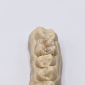 Onlay Composite 3DDI