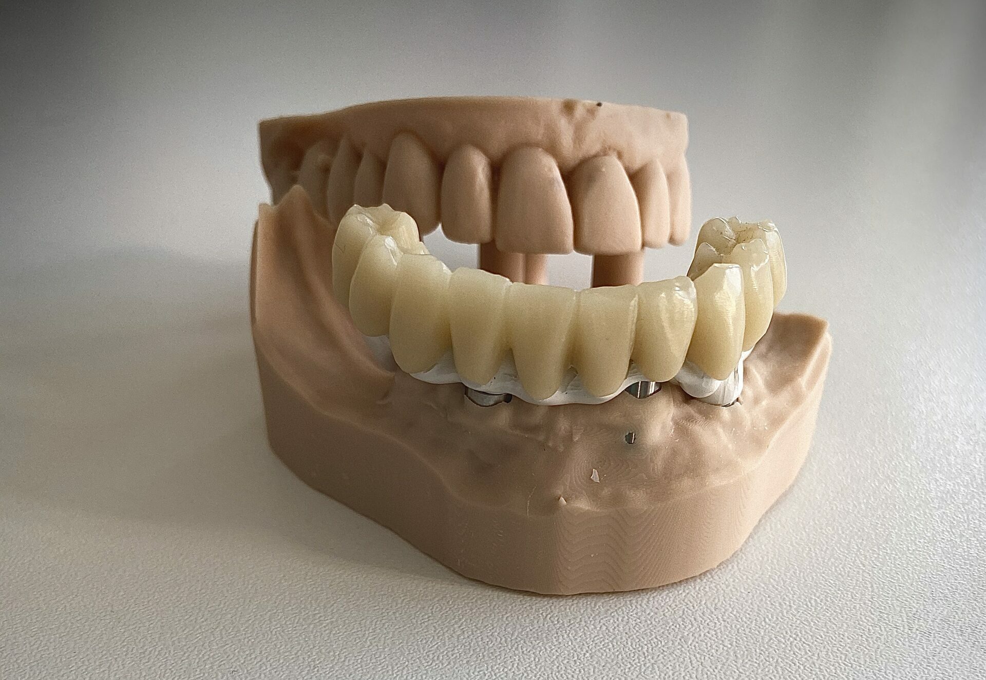 Couronne Provisoire Scellée / Transvissée Laboratoire 3D Dental Impression