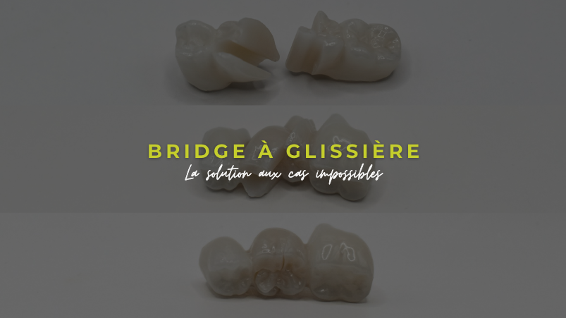 Bridge à glissière : la solution aux cas impossibles