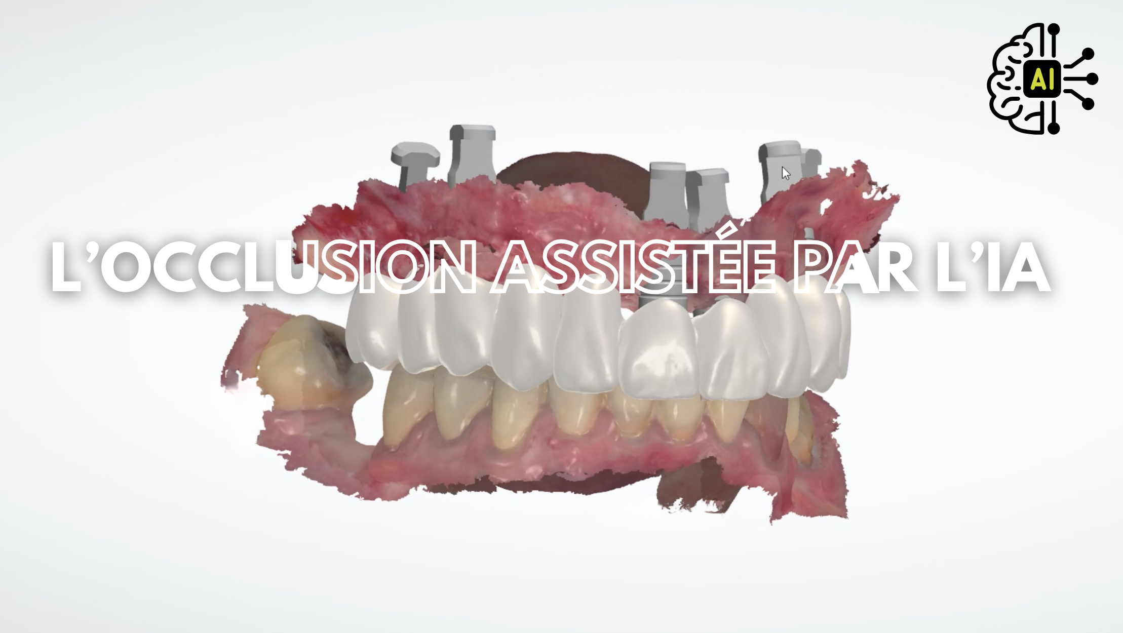 Les logiciels d’occlusion assistés par IA sont-ils fiables ?